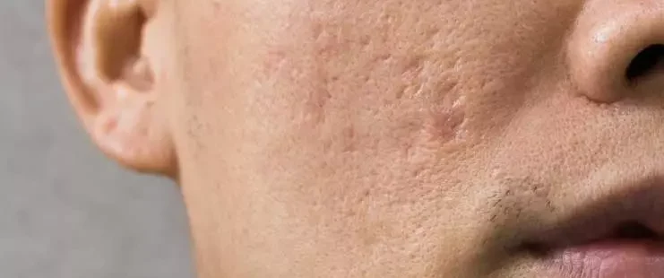 jerawat bisa menyebabkan bopeng